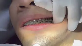 Những vật dụng quan trọng để giữ VSRM khi đang niềng răng