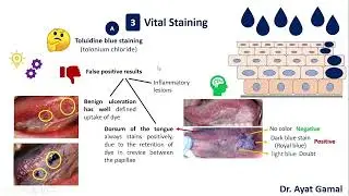 12. Oral Cancer screening test- III- staining- Part 1 (Toluidine blue)