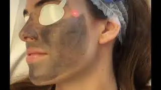 The Carbon Peel at MetroMD