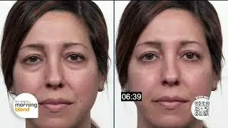 Fast Fix Beauty  Inside the Buzz Around Plexaderm