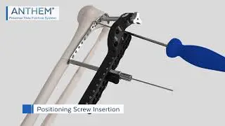ANTHEM&reg; Proximal Tibia Fracture System