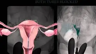 fallopian tube recannalization patient review