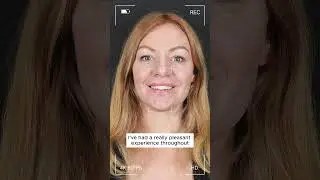 Zirconium Crowns Smile Transformation | Suzanne&rsquo;s Story from the UK