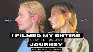 I Got A Rhinoplasty & Breast Augmentation On The Same Day (Beverly Hills Plastic Surgery Vlog + Q&A)