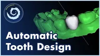 BSP V4.13: Automatic AI Tooth Design Now Available in Blue Sky Plan