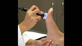 XTRAC Treatment - Feet