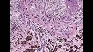 Histopathology Skin Pigmented Spindle Cell Nevus