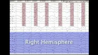 10   Diffuse Slow and PDs
