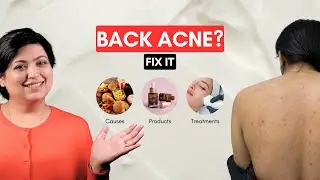 Back Acne Causes, Products & Treatments | Dermatologist Explains