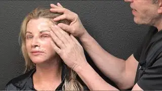 Kimberly traveled all the way from Canada to undergo a world-class facial rejuvenation by Dr. Sozer