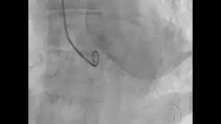 Transapical TAVI