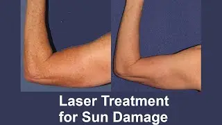 Sun Damage Laser Treatment