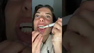 Luxissimo Teeth Whitening Kit in Use: Bright smile routine in under a minute.
