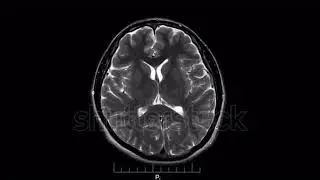 Human Brain MRI Scan, X-ray - Magnetic Resonance imaging of a brain, Ultra HD 4k, Time Lapse...