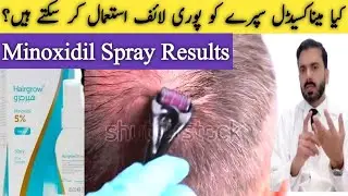 Minoxidil Spray Results : How many months Should Use to See hair Growth Results 