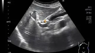 Ultrasound Video showing a mass in Porta hepatis.