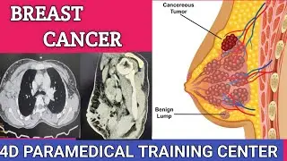 Breast cancer ,  CECT CHEST detect Breastcancer 😱#CHEST #cancer #breastcancer #ctscan #viralvideo 