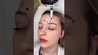 آموزش مارکینگ بوتاکس | Botox Injection Training