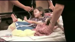 Conjoined twins successfully separated