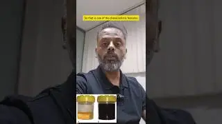 Alkaptonuria In 3 Minutes || Amino Acid Metabolism Disorder || Alkaptonuria  #neetpg2025