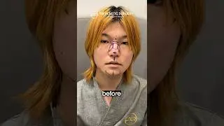 MTF Facial Feminization Dramatic Transformation! #koreanplasticsurgery