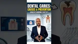 Dental Caries Causes and Prevention #dentalcaries #drmabhishek#healthtips #toothdecay #cavities