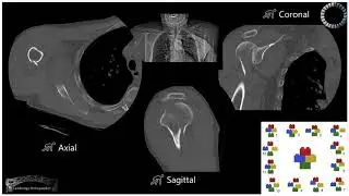 Cases - Shoulder Posterior dislocation