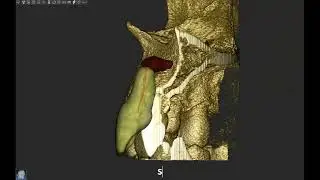 Acteon Imaging Suite 3D - Pulp canal segmentation