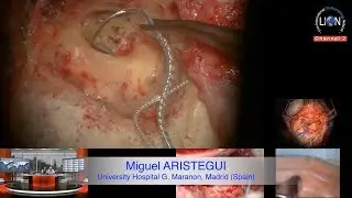 The 13th LION 2018 May Global Broadcast Subtotal petrosectomy with Nucleus cochlear implantation