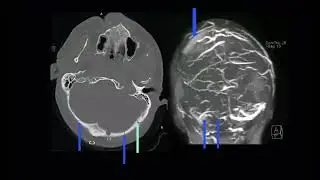 An Introduction to Conventional Imaging of Traumatic Brain Injury