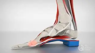 Treating Metatarsalgia | Try Vancouver Orthotics | Dr  Michael Horowitz | 604-737-3668
