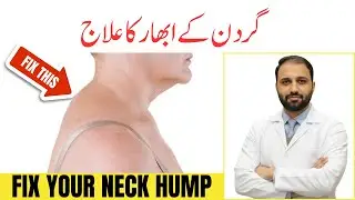How to Treat Neck Hump | Exercises to Fix Forward Head Posture & Dowager's Hump | Turtle Exercise