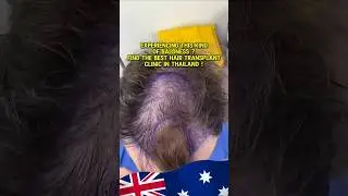 The best hair transplant clinic in Thailand #bangkokhairclinic #hairtransplant #hairlossnearme