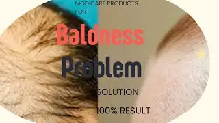Modicare Products for Baldness Problem Solution/Get rid of baldness/Modicare Health.