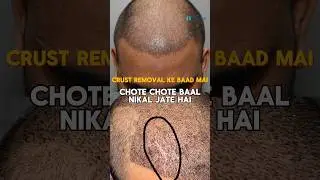 Losing hair during crust removal after hair transplant: Is it Normal? | Explained by Dr Jangid