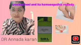 Cracked heel#effective homoeopathic medicine#diet#home remedy