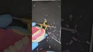 Maxillary Denture Wax-up