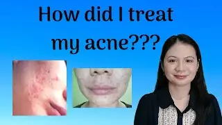 Tips For Acne and Pimple Free Skin