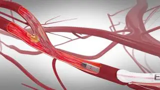 Silk Road Medical Procedure Animation