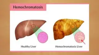 Inborn Errors of Metabolism & Their Genetic Basis