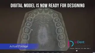 STEP 1: 3D Scan of Patient Teeth model or Intra-oral Scan | Indent Dental Laboratory, Mumbai