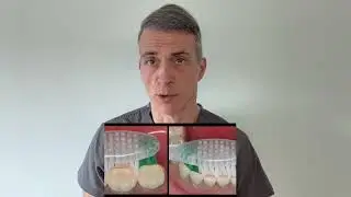 TRAUMA-INDUCED GINGIVAL RECESSION