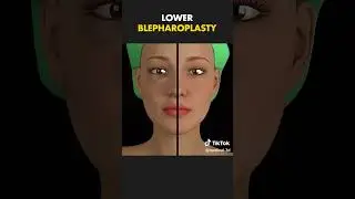 Small surgery to remove extra skin, fat, or muscle from the eyelids to make the eyes look more open
