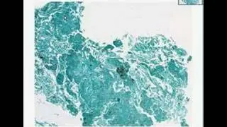 Histopathology Lung --Pneumocystis pneumonia