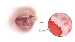 Your Dental Health: Dr John Kenney: Lichen Planus