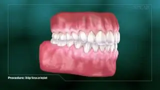 Bridge vs Implant