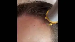 L&aacute;ser Vascular estrellas ara&ntilde;as vasculares Удаление красных точек сосудов сосудистых звездочек Лазер