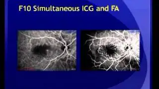 Puliafito Multi Wavelength Laser Ophthalmoscopy