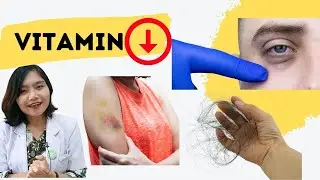 20 ПРИЗНАКОВ НЕДОСТАТОЧНОСТИ ОПРЕДЕЛЕННЫХ ВИТАМИНОВ | доктор Эмасуперр