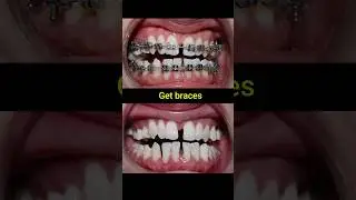Braces evolution #braces #orthodontist #dentist #dental